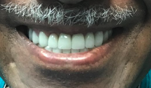 After cosmetic dentistry in Baltimore, MD