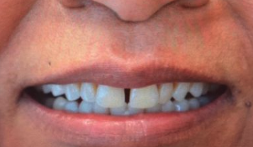 Before cosmetic dentistry in Baltimore, MD