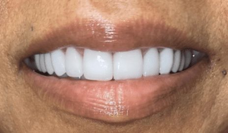 After cosmetic dentistry in Baltimore, MD