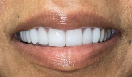 After cosmetic dentistry in Baltimore, MD