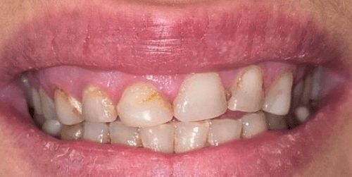 Before cosmetic dentistry in Baltimore, MD