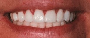 After cosmetic dentistry in Baltimore, MD