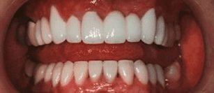 After cosmetic dentistry in Baltimore, MD