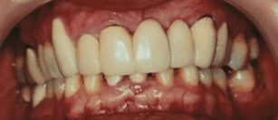 Before cosmetic dentistry in Baltimore, MD