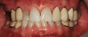 Before cosmetic dentistry in Baltimore, MD