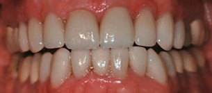 After cosmetic dentistry in Baltimore, MD