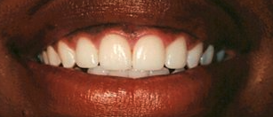After cosmetic dentistry in Baltimore, MD
