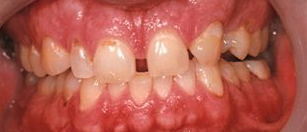 Before cosmetic dentistry in Baltimore, MD