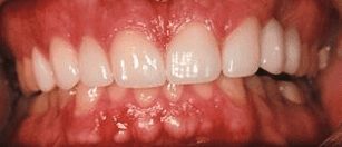 After cosmetic dentistry in Baltimore, MD