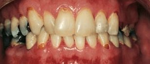 Before cosmetic dentistry in Baltimore, MD
