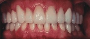 After cosmetic dentistry in Baltimore, MD