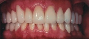 After cosmetic dentistry in Baltimore, MD