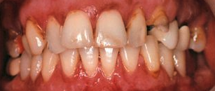 Before cosmetic dentistry in Baltimore, MD