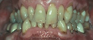 Before cosmetic dentistry in Baltimore, MD