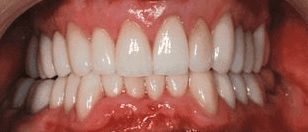 After cosmetic dentistry in Baltimore, MD