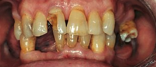Before cosmetic dentistry in Baltimore, MD