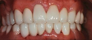 After cosmetic dentistry in Baltimore, MD