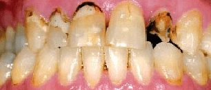 Before cosmetic dentistry in Baltimore, MD