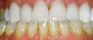After cosmetic dentistry in Baltimore, MD
