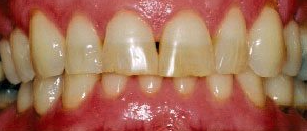 Before cosmetic dentistry in Baltimore, MD