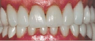 After cosmetic dentistry in Baltimore, MD