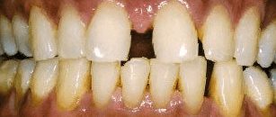 Before cosmetic dentistry in Baltimore, MD