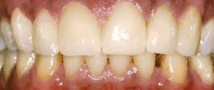 After cosmetic dentistry in Baltimore, MD