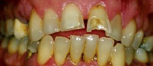Before cosmetic dentistry in Baltimore, MD
