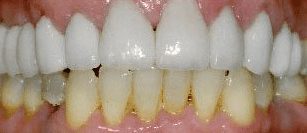 After cosmetic dentistry in Baltimore, MD