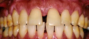 Before cosmetic dentistry in Baltimore, MD