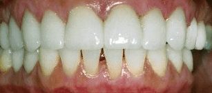 After cosmetic dentistry in Baltimore, MD