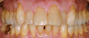 Before cosmetic dentistry in Baltimore, MD