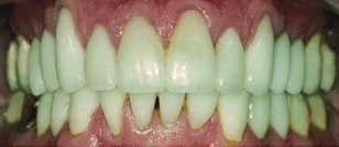 After cosmetic dentistry in Baltimore, MD