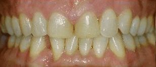 Before cosmetic dentistry in Baltimore, MD