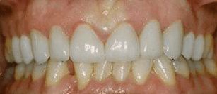 After cosmetic dentistry in Baltimore, MD