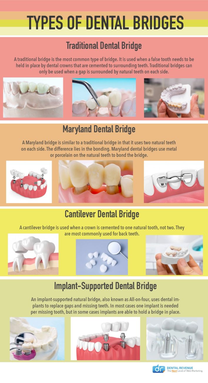 Types of Dental Bridges infographic