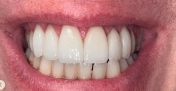 After cosmetic dentistry in Baltimore, MD