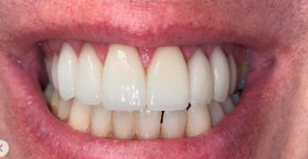 After cosmetic dentistry in Baltimore, MD