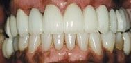 After cosmetic dentistry in Baltimore, MD
