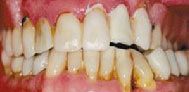 Before cosmetic dentistry in Baltimore, MD