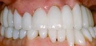 After cosmetic dentistry in Baltimore, MD