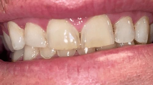 Before cosmetic dentistry in Baltimore, MD
