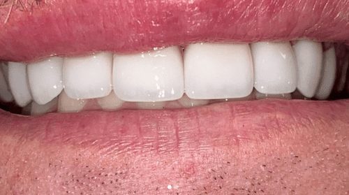 After cosmetic dentistry in Baltimore, MD