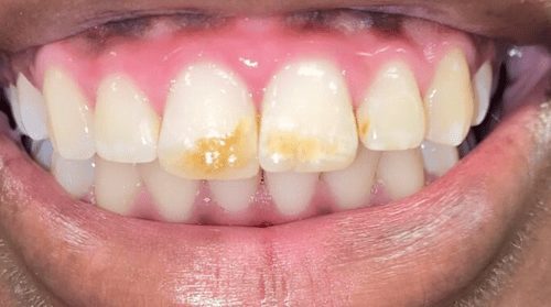 Before cosmetic dentistry in Baltimore, MD