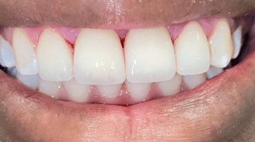 After cosmetic dentistry in Baltimore, MD