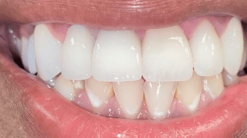 After cosmetic dentistry in Baltimore, MD