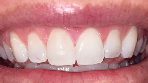 Before cosmetic dentistry in Baltimore, MD