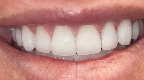After cosmetic dentistry in Baltimore, MD