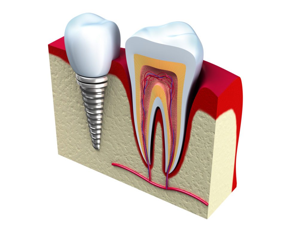 Dental Implants in Towson, MD