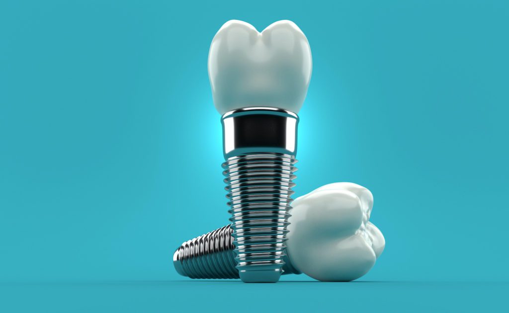 dental implants in greenspring, maryland